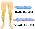Peripheral Neuropathy - Types, Causes, Symptoms, Diagnosis, Treatment & Prevention