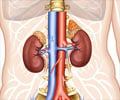 Pheochromocytoma |  Adrenal Gland Tumor: Causes, Symptoms, Diagnosis, Treatment, Prevention Pheochromocytoma |  Adrenal Gland Tumor: Causes, Symptoms, Diagnosis, Treatment, Prevention