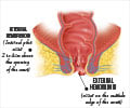 Hemorrhoids | Piles - Types, Causes, Symptoms, Diagnosis