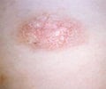 Pityriasis Rosea
