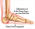 Plantar Fasciitis - Causes, Symptoms, Diagnosis, Treatment