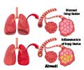 Pneumonitis - Non-infective Inflammation of Lung