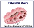 Polycystic Ovarian Syndrome - Overview