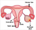 Premature Ovarian Failure - Causes Clinical features Investigations Management