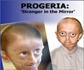 Progeria – Symptoms – Genetics – Diagnosis – Treatment - Prognosis