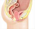 Uterine Prolapse / Prolapse of Uterus - Causes-Symptoms-Treatment