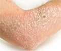 Psoriasis  About