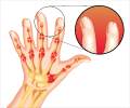 Psoriatic Arthritis - Types, Causes, Risk Factors, Diagnosis, Treatment, Prevention & Management