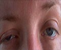 Ptosis