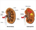 Pyelonephritis