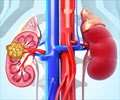 Radiofrequency Ablation (RFA) of Kidney Tumors