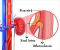 Renal Artery Stenosis (RAS) - Causes, Symptoms, Diagnosis, Treatment, Risk Factors Renal Artery Stenosis (RAS) - Causes, Symptoms, Diagnosis, Treatment, Risk Factors