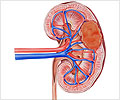 Renal Cell Carcinoma-Causes-Risk Factors-Symptoms-Diagnosis-Treatment-Prevention