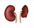 Renal Tuberculosis - Causes, Symptoms, Complications, Diagnosis & Treatment