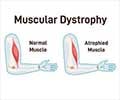 Can Muscle Atrophy be Reversed? Can Muscle Atrophy be Reversed?