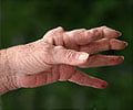 Rheumatoid Arthritis
