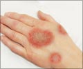 Ringworm | Tinea | Dermatophytosis: Causes Symptoms Signs Treatment FAQ