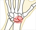 Scaphoid Fracture of The Wrist - Causes Symptoms Diagnosis Treatment