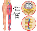 Sciatica Sciatica