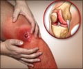 Septic Arthritis | Infectious Arthritis: Causes, Symptoms, Diagnosis, Treatment