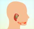 Sialadenitis |Salivary Gland Inflammation