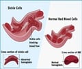 Sickle Cell Anemia–Causes-Symptoms-Diagnosis-Treatment–Prognosis