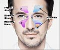 Sinus Headaches - Causes Symptoms Treatment
