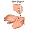 Skin Biopsy video Skin Biopsy video