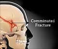 Skull Fractures – Types, Symptoms, Signs, Diagnosis, Treatment & Health Tips Skull Fractures – Types, Symptoms, Signs, Diagnosis, Treatment & Health Tips