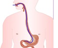 Small Intestine Biopsy-Purpose-Precaution-After Biopsy-Risks-FAQ