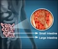 Small Intestinal Cancer Risk Factors Symptoms Diagnosis Treatment Prevention