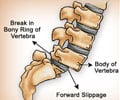 Spondylolisthesis - Causes Symptoms Diagnosis Treatment Prevention