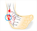 Sprained Ankle | Ankle Sprains