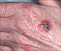 Squamous Cell Cancer of the Skin