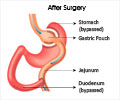 Stomal Stenosis following Gastric Bypass Surgery - Causes, Symptoms, Diagnosis and Treatment
