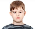 Strabismus | Squint - Types, Causes, Symptoms, Diagnosis, Treatment & Prevention