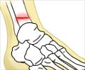 Stress Fracture - Causes, Symptoms, Diagnosis, Treatment