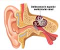 Superior Canal Dehiscence