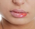 Swollen Lips | Lip Edema Symptom Evaluation