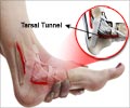 Tarsal Tunnel Syndrome Causes Symptoms Signs Diagnosis Treatment Tarsal Tunnel Syndrome Causes Symptoms Signs Diagnosis Treatment