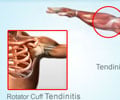 Tendinitis | Tendonitis: Causes, Symptoms, Diagnosis & Treatment Tendinitis | Tendonitis: Causes, Symptoms, Diagnosis & Treatment
