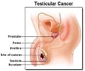 Testicular Cancer