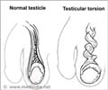 Testicle Pain - Symptom Evaluation Testicle Pain - Symptom Evaluation