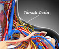 Thoracic Outlet Syndrome Thoracic Outlet Syndrome