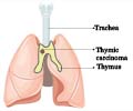 Thymus Cancer - Causes, Symptoms, Diagnosis, Treatment & Prognosis