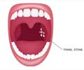 Tonsil Stones - Causes, Symptoms, Diagnosis, Treatment and Prevention Tonsil Stones - Causes, Symptoms, Diagnosis, Treatment and Prevention