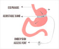 Top 15 Health Benefits of Bariatric Surgery Top 15 Health Benefits of Bariatric Surgery