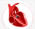 Transcatheter Aortic Valve Replacement: Opening Doors to a Second Chance Transcatheter Aortic Valve Replacement: Opening Doors to a Second Chance