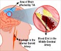 Transient Ischemic Attack