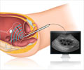 Transvaginal Ultrasound Transvaginal Ultrasound